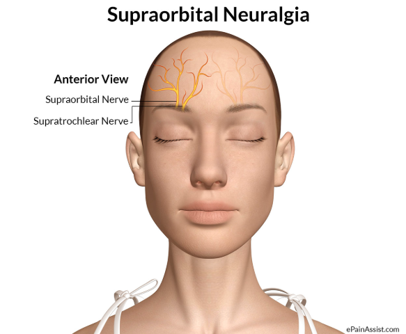 headache after swimming, supraorbital nerve, nerve pain, facial pain, swimming, headache